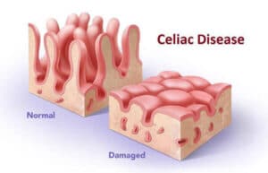 celiac-disease
